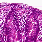 Dissarray of the columnar epithelium