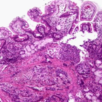 Infiltration of submucosa