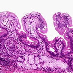 Nest of tumour cells in lamina propria mucosae. HE