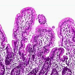 Inflammatory infiltration of lamina propria