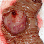 GIST of the jejunum