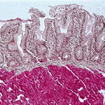 Amyloidosis of the jejunum