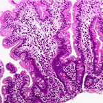 Infiltration of lamina propria with lymphocytes