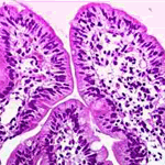 Infiltration of lamina propria with lymphocytes