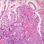 Intestinal wall with massive infiltration