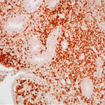 Tumour cells show expression of CD - 45 R0