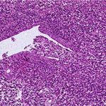 Partly destroyed mucosal gland