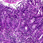 Severe inflammatory infiltration