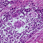 Well formed granuloma