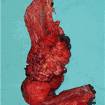 Surgical specimen of resected bowel