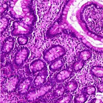 Enlargement of villi filled by foamy macrophages