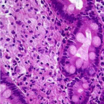 Enlargement of villi filled by foamy macrophages