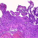 Metatstasis of the haemangiosarcoma