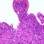 Metatstasis of the haemangiosarcoma