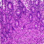 Undifferentiated cell bronchogenous carcinoma