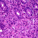 Tumour cell infiltration