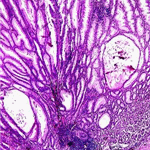 Typical hamartomatous polyp. HE