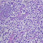 Seminoma reveals histologically solid growth ...