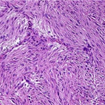Spindle cell tumour with fascicular arrangement