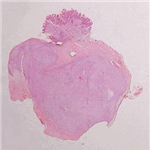 Duodenal GISToma