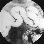 Coeliac Disease