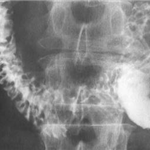 Jejunal Lymphoma