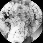 Normal enteroclysis