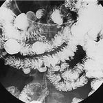 Multiple diverticula of duodenum and jejunum