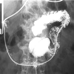 Multiple diverticula of duodenum and jejunum