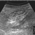 Thickened wall of distal ileum