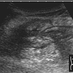 Inflammatory changes of the ileocoecal junction