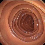 Normal jejunum 