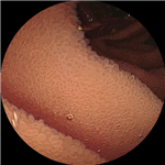 Normal jejunum 