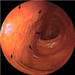 Normal ileum 