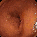 Normal terminal ileum 