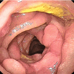 Small bowel lymphoma.