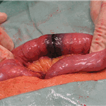 Small bowel lymphoma.