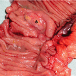 Small bowel lymphoma.
