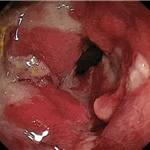 Coeliac disease