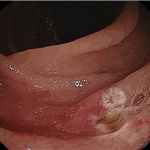 Arterial-venous malformation (arrow)