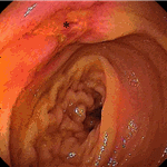 NSAID enteropathy