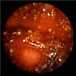 Submucosal arteriovenous haemangioma of jejunum