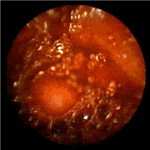 Submucosal arteriovenous haemangioma of jejunum