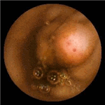 Several sessile polyps in ileum