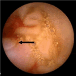 GIST of the jejunum