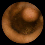 Several sessile polyps in ileum