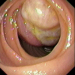 GIST of the jejunum