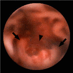 Proximal jejunum