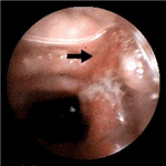 T - cell  lymphoma of the ileum