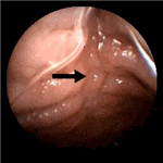 T - cell  lymphoma of the ileum